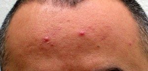 Cómo evitar los granos en la cara