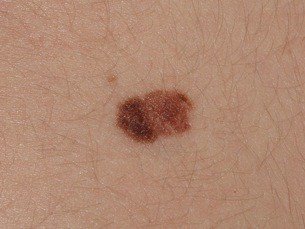 Cómo quitar lunares sin cirugía