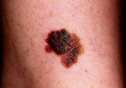 Cómo quitar lunares sin cirugía