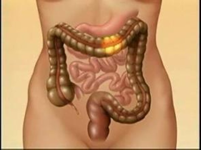 El colon irritado y sus recetas