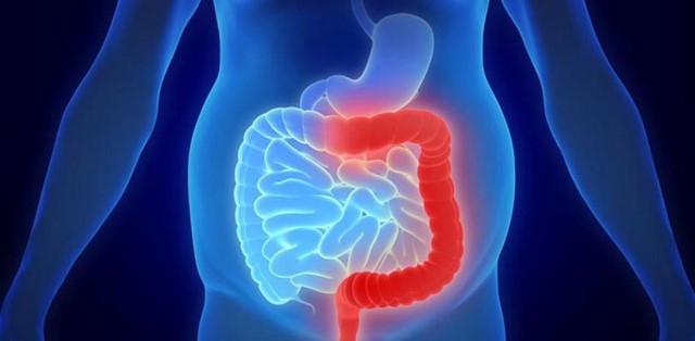 colitis