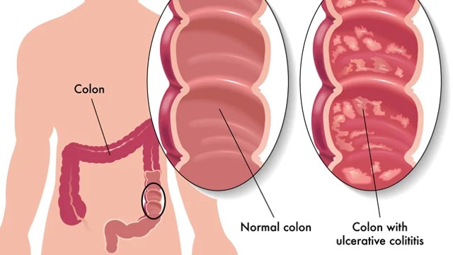 colitis