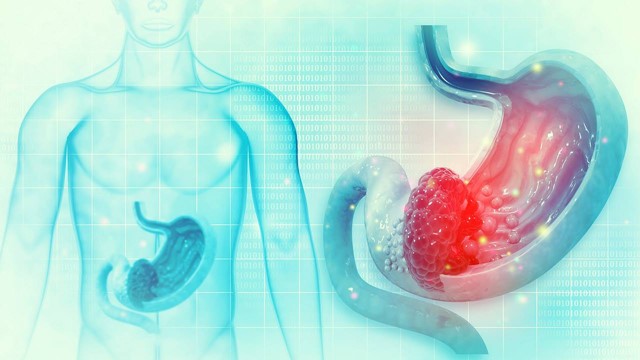 La gastritis y sus recetas recomendadas