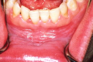 Cómo tratar la gingivitis