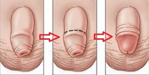 Cómo es la operación de fimosisa