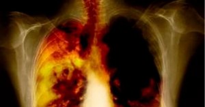 Curas para el adenocarcinoma: cáncer de pulmón y de colon