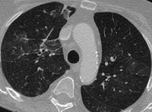 Cuáles son los síntomas de la neumonía