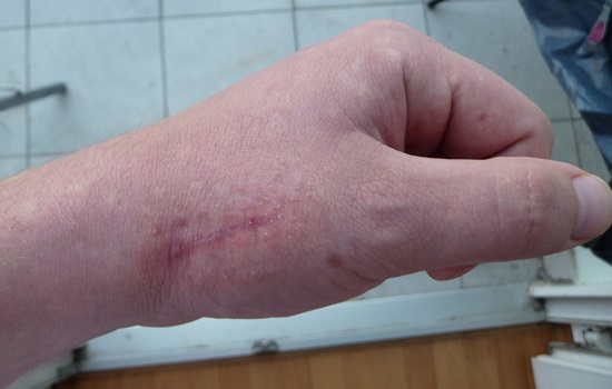 Cómo mejorar el aspecto de las cicatrices