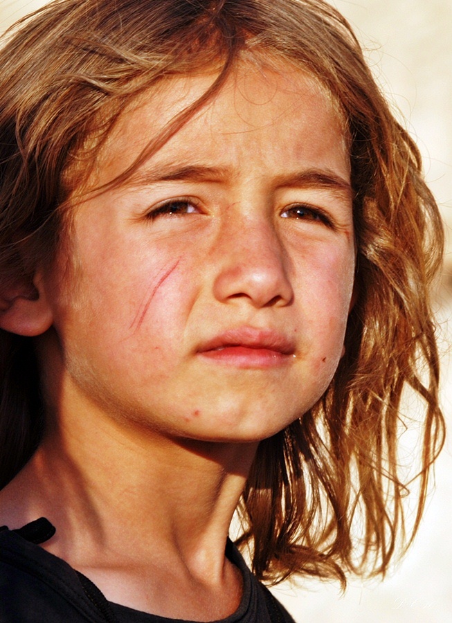 Cómo mejorar el aspecto de las cicatrices