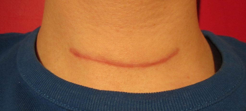 Cómo mejorar el aspecto de las cicatrices