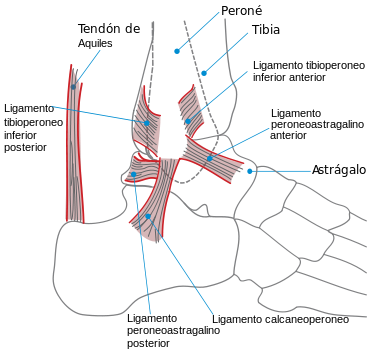 Cómo tratar un esguince de tobillo