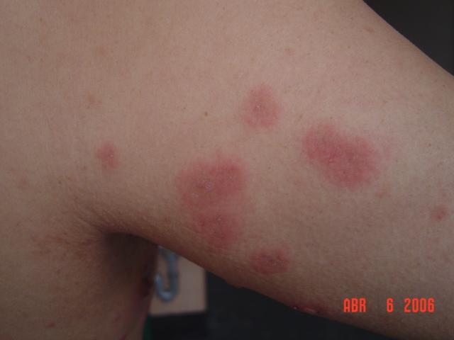 Cómo curar la dermatitis