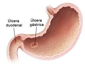 Úlcera Péptica Causas Síntomas y Tratamiento de las Úlceras Pépticas Salud Doncomos com