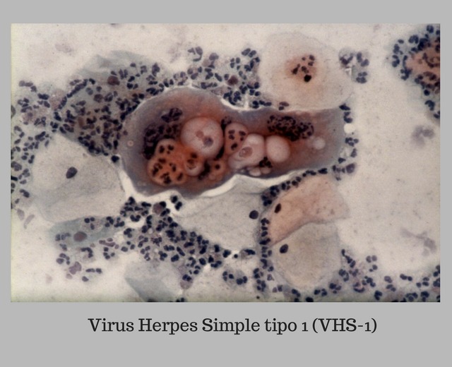 herpes simple