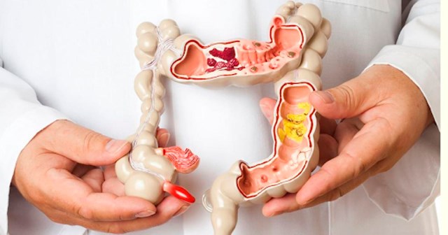 El colon inflamado