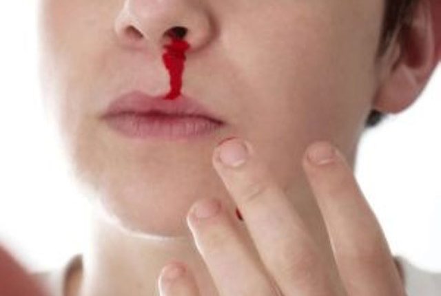 ¿Que tengo que hacer si sangro por la nariz?